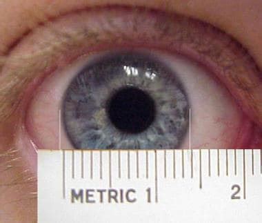 Megalocornea: Background, Pathophysiology, Epidemiology