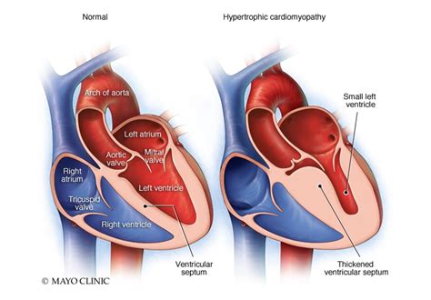 Concomitant mitral valve intervention may increase risk for patients ...