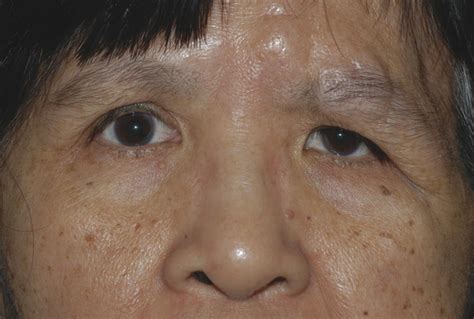 4 Mechanical Ptosis Etiology And Management Ento Key