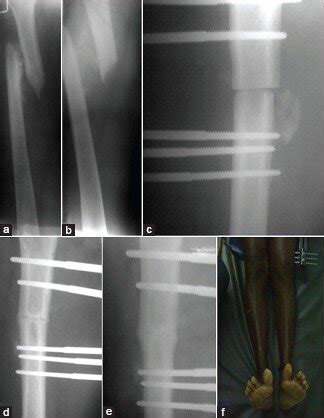 X Ray Anteroposterior A And Lateral B View Of Thigh Showing