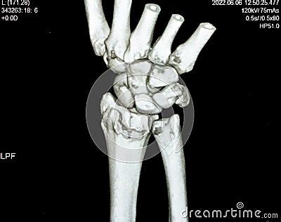 Ct Scan Right Wrist Joint D View Shows Right Distal Radius Fracture