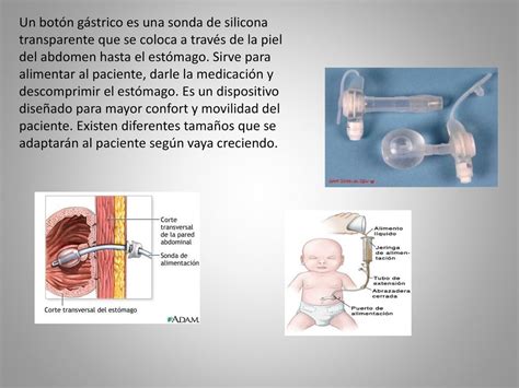 Cuidados Da Sonda Peg Ou Sonda Para Gastrostom A N G Strico