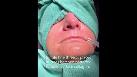 Smooth Pdo Threads At St Charles County Dermatologic Surgery Youtube