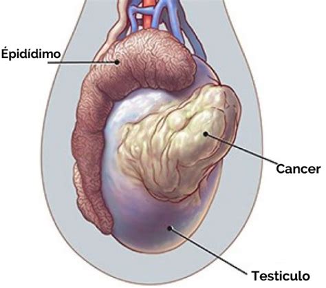 Enfermedades De Los Testículos Dr Esteban López Giácoma Elg Urología