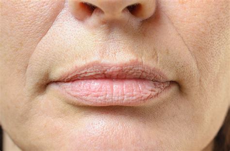 Remove Above Lip Wrinkle Treatment Outlet Laseb Fae Ufmg Br