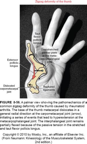 PacificU Biomechanics Hand Deformities Final Flashcards Quizlet