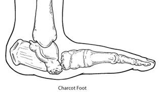 Charcot Foot