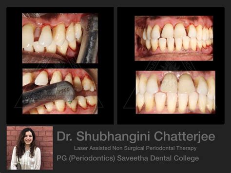 Laser Assisted Non Surgical Periodontal Therapy Periodontics Saveetha