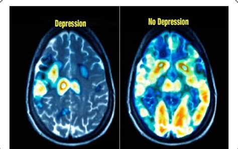 How Does Depression Affect The Brain Depressed Brain Meaning Dr