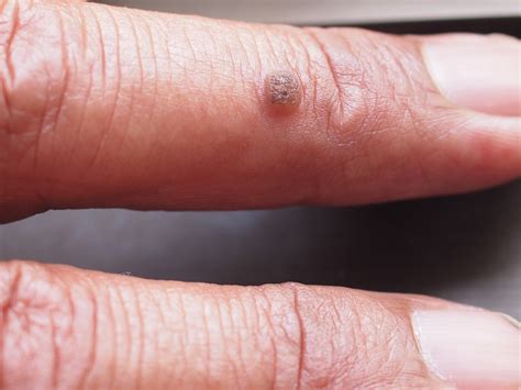 Warts