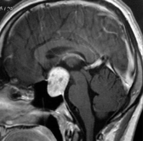 Magnetic Resonance Imaging Sagittal View Depicting Pituitary Adenoma