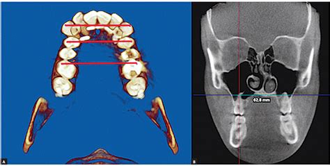 Scielo Brasil Three Dimensional Evaluation Of Alveolar Bone Changes