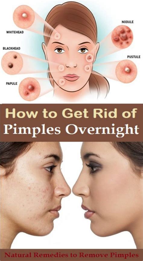 Ways To Eliminate Pimples Overnight Naturally And Fast Dailyhealthyweb How To Remove