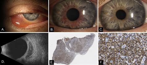 Orbital And Intraocular Lymphoma In Contralateral Eyes A Case Of