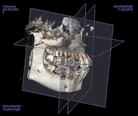 Cbct Reference Planes Median Sagittal Plane Msp Horizontal Plane