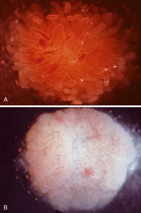 Inflammatory Disorders Of The Small Intestine Clinical Tree