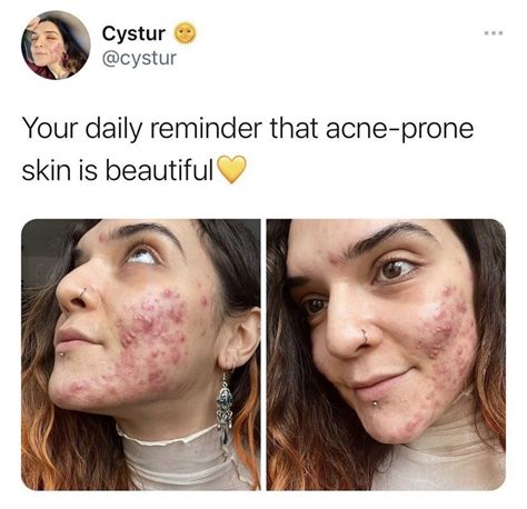 You’re Beautiful Bad Acne Celebrity Acne Skin Care