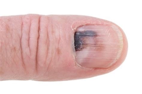 15 Disturbing Things Your Nails Reveal About Your Health Page 2