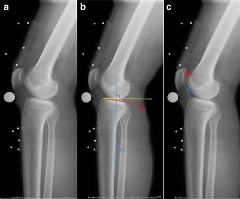 Measurement Of Posterior Tibial Slope Angle PTSA And Patellar Height