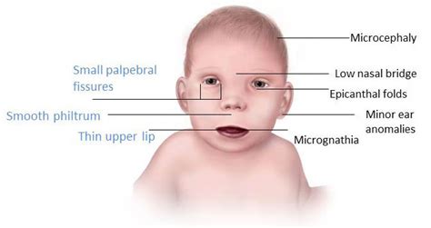 Signs and symptoms for baby's - Change your relationship with alcohol