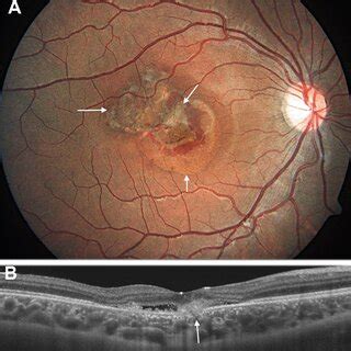 Color Fundus Photograph Clarus Zeiss Of Right Eye Reveals