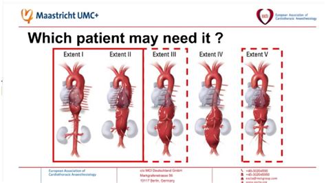 EACTA Vascular Webinar 4 Practical Aspects Of CSF Drainage In TEVAR