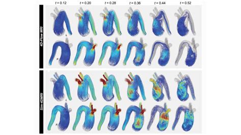 Novel Validation Of Patient Specific Blood Flow Model Stanford