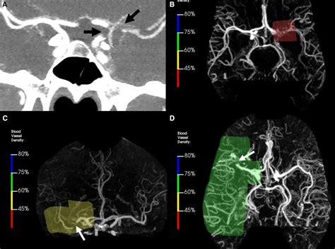 Automated Detection Of Intracranial Large Vessel Occlusions On Computed