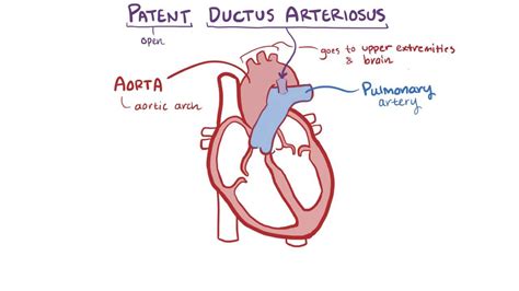 Patent Ductus Arteriosus Video Anatomy Definition Osmosis