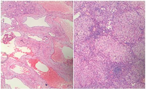 Adult Hepatic Cavernous Hemangioma With Highly Elevated α Fetoprotein A Case Report And Review