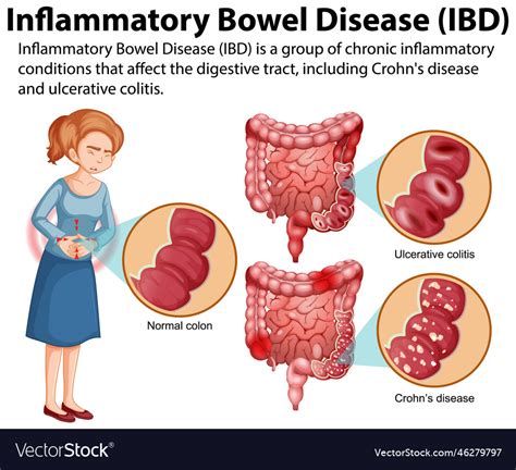 Inflammatory Bowel Disease Ibd Symptoms Causes 40 Off