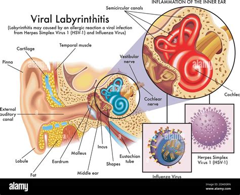 An illustration of an inflamed inner ear caused by the herpes simplex ...