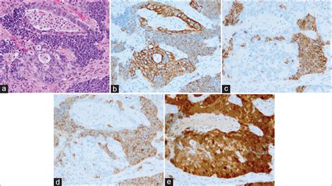 Cytological Features Of Adenocarcinoma Admixed With Small Cell