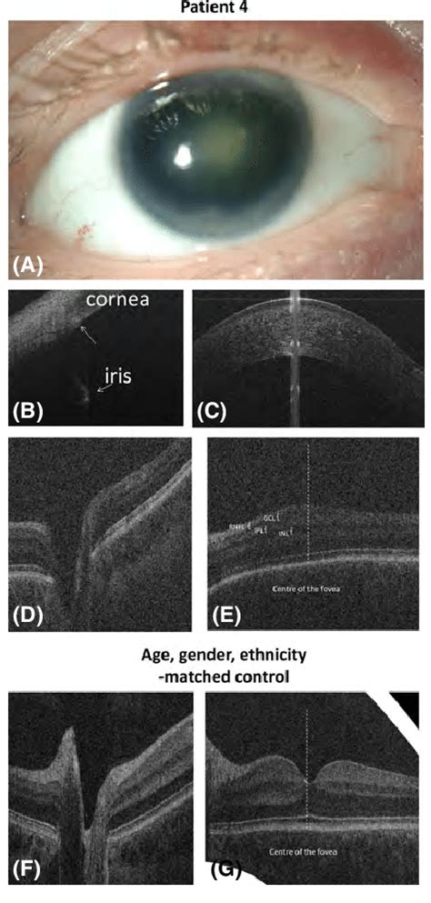 Anterior Segment Photography A And Spectral Domain Optical Coherence Download Scientific