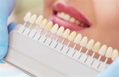 Porcelain Veneers vs. Teeth Whitening - HealthIcu