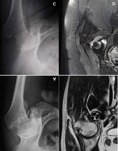 Primary Synovial Chondromatosis Of The Right Hip In A 58 Year Old Woman