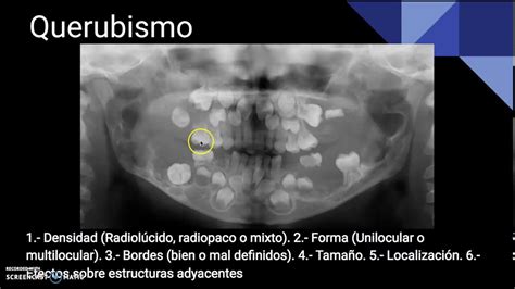 Interpretaci N De Lesiones Radiopacas Radiol Cidas Y Mixtas Parte