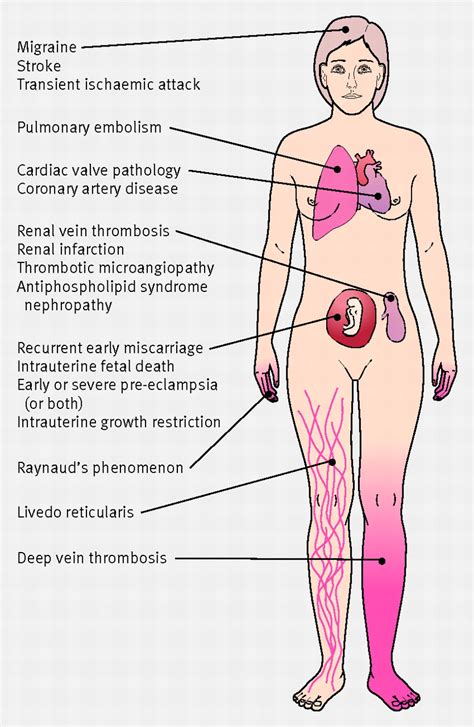 Diagnosis And Management Of The Antiphospholipid Syndrome The Bmj