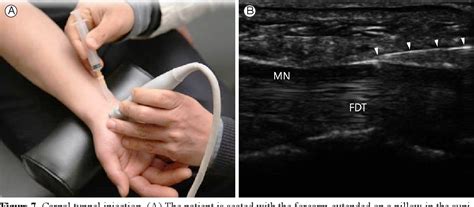 Figure 1 From Ultrasound Guided Intra Articular Injections Semantic Scholar