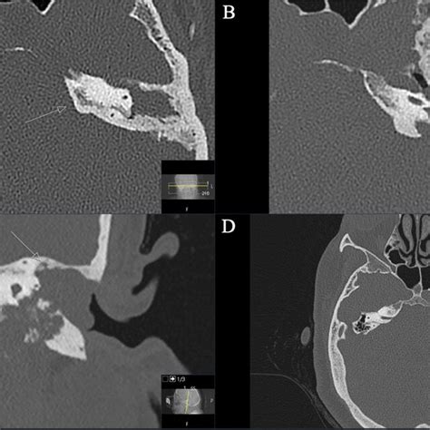 A Preoperative Axial Ct Scan Displaying An Enlarged Gspn Canal In The