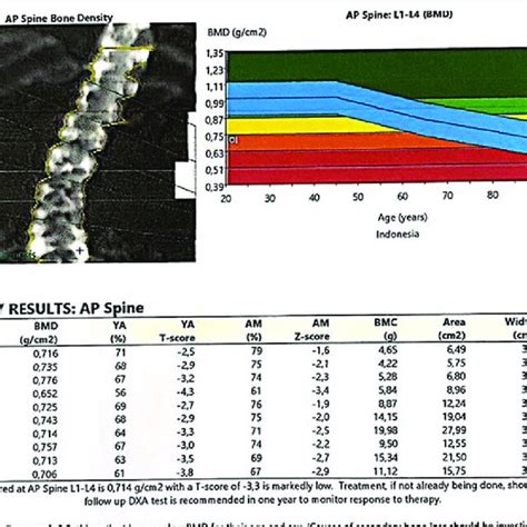 Bone Mineral Densitometry Results A Left Femur Bone Density The Bmd