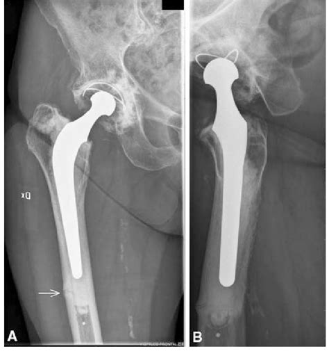 A B A Anteroposterior And B Lateral Radiographs Of Patient 1 Were