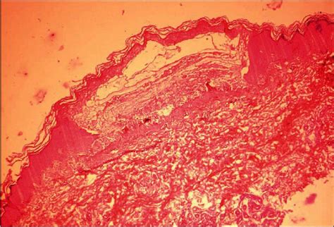 Histopathology Of Skin Lesions Revealing Subepidermal Split H And E Download Scientific