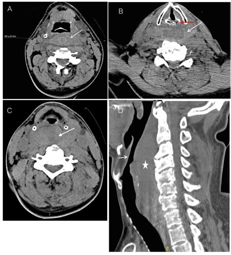 Precipitous airway obstruction in acute retropharyngeal hematoma ...