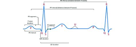 The Normal Ecg Signal Picturing The Pp Pr Rr Qt Intervals And The R Download Scientific