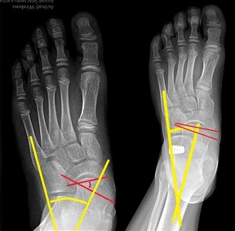 Preoperative Left And Postoperative Right Image Of The Same Foot