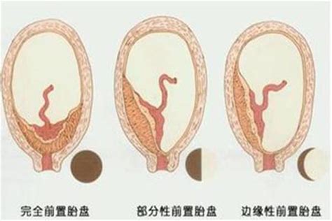 前壁胎盤≠前置胎盤，如果有揪心的胎盤低置或前置胎盤，怎麼辦？ 每日頭條