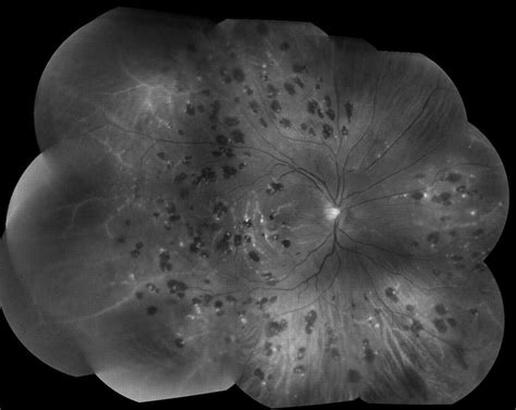 Systemic Lupus Erythematosus Associated Retinal Vasculitis The