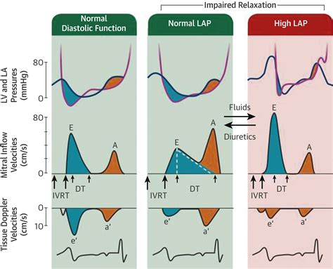 Left Ventricular Diastolic Function Understanding Pathophysiology Diagnosis And Prognosis