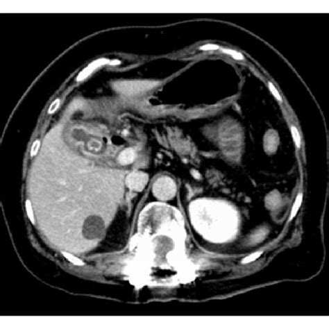 Computed Tomography Ct Images Showing A Small Bowel Obstruction By